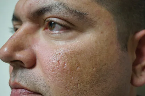 Fig 4. Fitzpatrick skin type V cheek with post-inflammatory hyperpigmentation and textural scarring after an inflammatory insult.